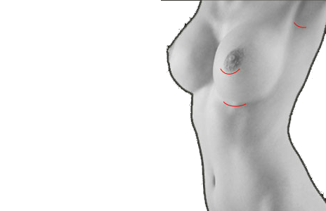 BREAST AUGMENTATION - PROCEDURES